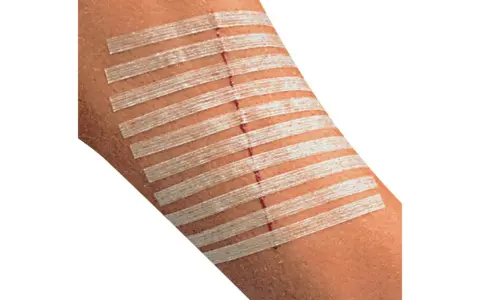Rana na przedramieniu zabezpieczona plastrami zamiast szwów. Delikatne paski przytrzymują skórę, przyspieszając gojenie.