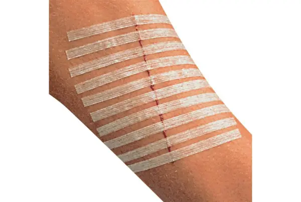 Rana na przedramieniu zabezpieczona plastrami zamiast szwów. Delikatne paski przytrzymują skórę, przyspieszając gojenie.